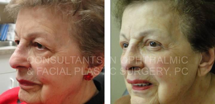 Lower Eyelid and Upper Eyelid Blepharoplasty - Consultants in Ophthalmic and Facial Plastic Surgery