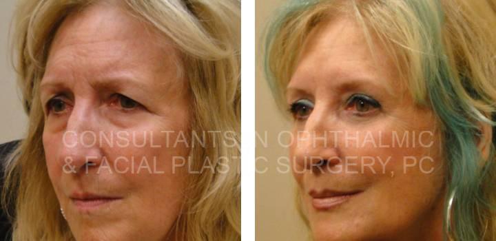 Lower Eyelid and Upper Eyelid Blepharoplasty - Consultants in Ophthalmic and Facial Plastic Surgery