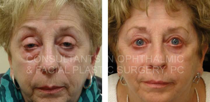 Lower Eyelid Blepharoplasty and Repair Ptosis Both Upper Eyelids - Consultants in Ophthalmic and Facial Plastic Surgery