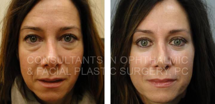 Lower Eyelid Blepharoplasty - Consultants in Ophthalmic and Facial Plastic Surgery