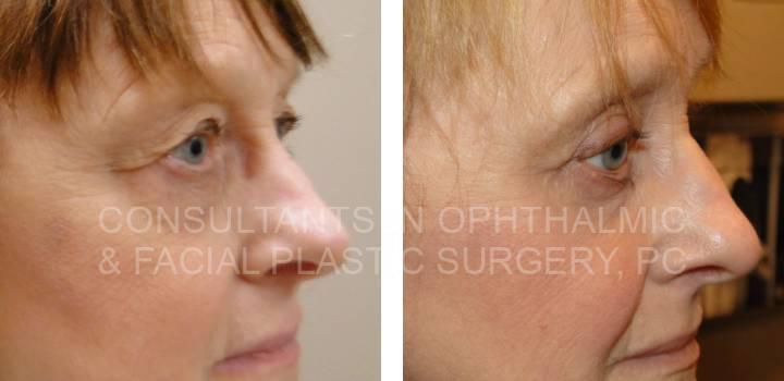 Both Upper and Both Lower Eyelid Blepharoplasty - Consultants in Ophthalmic and Facial Plastic Surgery
