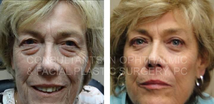 Both Upper and Both Lower Eyelid Blepharoplasty - Consultants in Ophthalmic and Facial Plastic Surgery