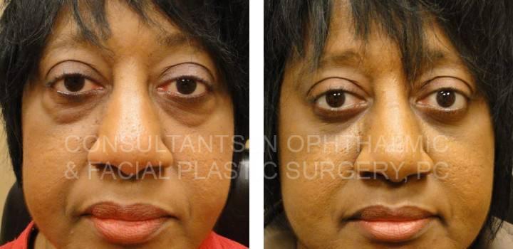 Lower Eyelid Blepharoplasty - Consultants in Ophthalmic and Facial Plastic Surgery