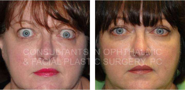 Repair Retraction Both Upper Eyelids - Consultants in Ophthalmic and Facial Plastic Surgery