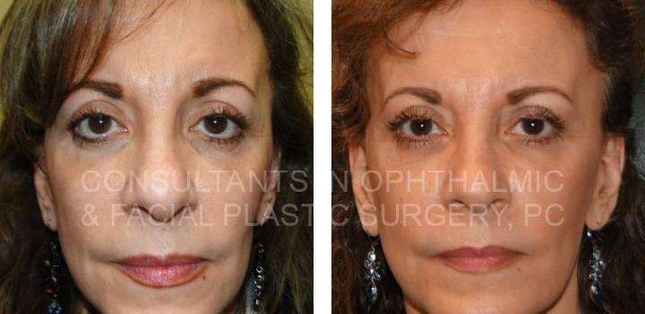 Reconstruction and Retraction Repair Both Lower Eyelids - Consultants in Ophthalmic and Facial Plastic Surgery