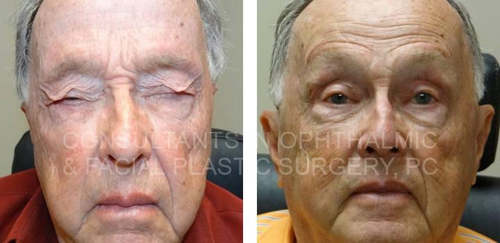 Blepharoplasty Both Upper Eyelids and Repair Ptosis Both Upper Eyelids - Consultants in Ophthalmic and Facial Plastic Surgery
