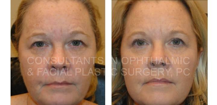 Blepharoplasty Both Upper Eyelids - Consultants in Ophthalmic and Facial Plastic Surgery