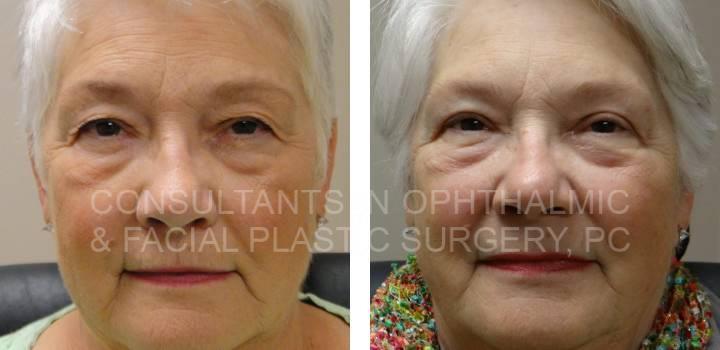 Blepharoplasty and Repair Ptosis Both Upper Eyelids - Consultants in Ophthalmic and Facial Plastic Surgery