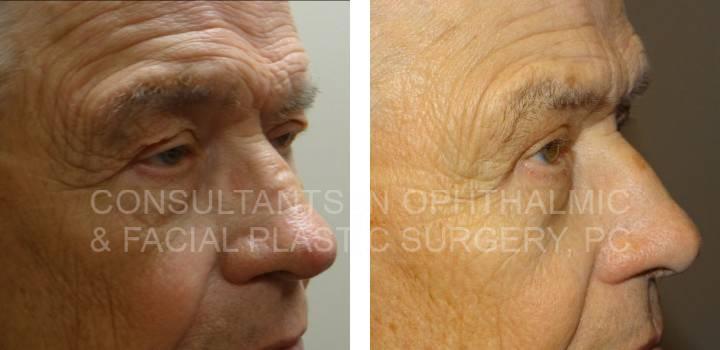 Repair Ptosis and Blepharoplasty Both Upper Eyelids - Consultants in Ophthalmic and Facial Plastic Surgery