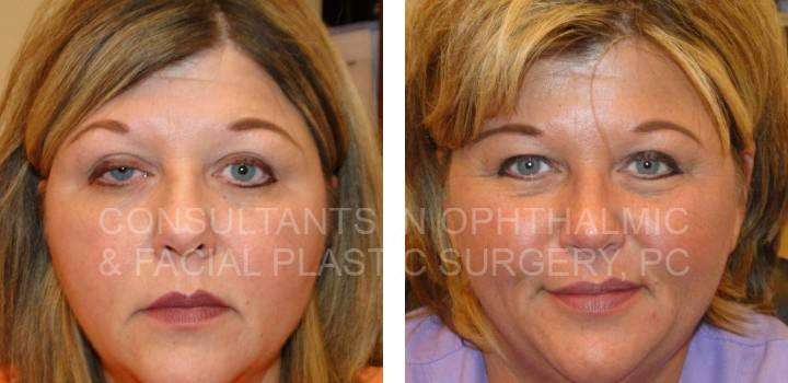 Right Upper Eyelid Ptosis Repair - Consultants in Ophthalmic and Facial Plastic Surgery