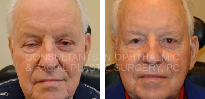 Upper Eyelid Ptosis Repair - Consultants in Ophthalmic and Facial Plastic Surgery