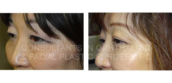 Blepharoplasty Both Upper Eyelids and Both Lower Eyelids - Consultants in Ophthalmic and Facial Plastic Surgery