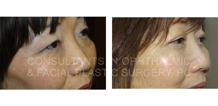 Blepharoplasty Both Upper Eyelids and Both Lower Eyelids - Consultants in Ophthalmic and Facial Plastic Surgery