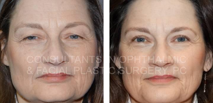 Blepharoplasty Upper Eyelids and Repair Ptosis Both Upper Eyelids - Consultants in Ophthalmic and Facial Plastic Surgery