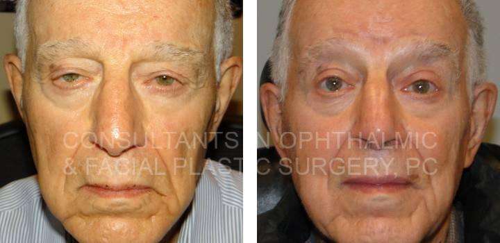Upper Eyelid Ptosis Repair - Consultants in Ophthalmic and Facial Plastic Surgery