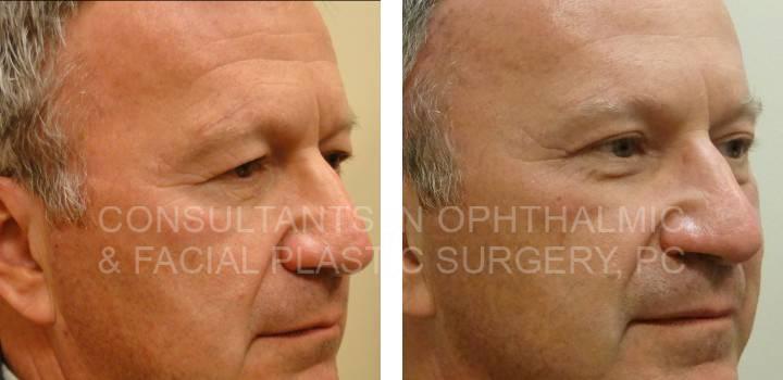 Bilateral Endoscopic Forehead Lift, Blepharoplasty and Ptosis Repair Both Upper Eyelids, and Co2 Laser Both Lower Eyelids - Consultants in Ophthalmic and Facial Plastic Surgery