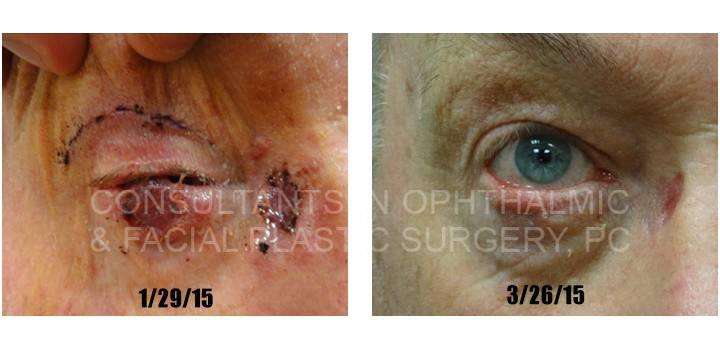 Left Lower Eyelid Hughes Procedure - Eyelid Pros
