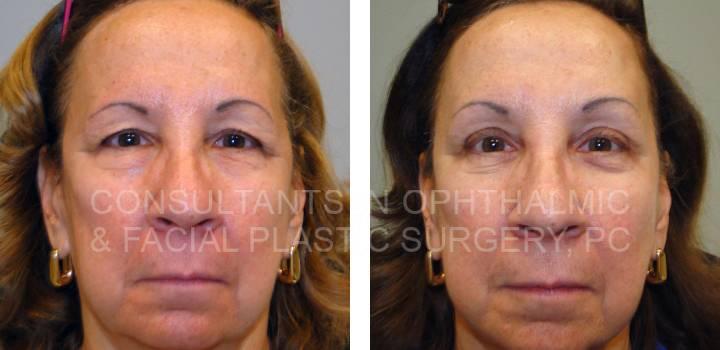 Bilateral Endoscopic Forehead Lift, Blepharoplasty Both Upper and Lower Eyelids, Co2 Laser Both Lower Eyelids - Consultants in Ophthalmic and Facial Plastic Surgery