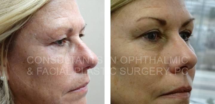 Blepharoplasty Both Upper Eyelids and Repair Ptosis Both Upper Eyelids - Consultants in Ophthalmic and Facial Plastic Surgery