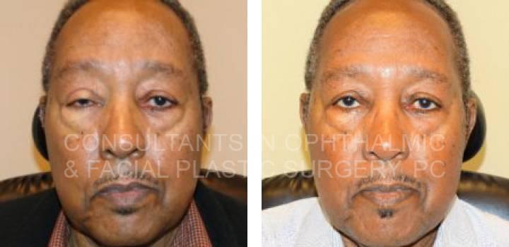 Ptosis Repair for Both Upper Eyelids - Consultants in Ophthalmic and Facial Plastic Surgery