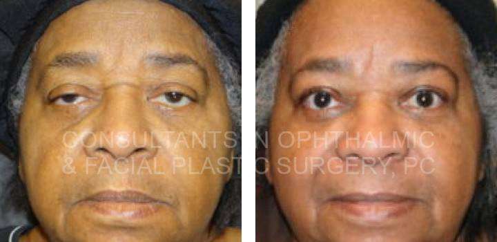 Ptosis Repair for Both Upper Eyelids - Consultants in Ophthalmic and Facial Plastic Surgery