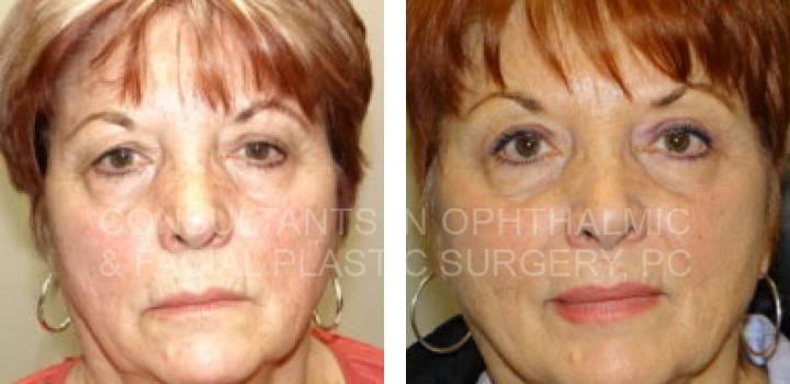 Bilateral Endoscopic Forehead Lift, Blepharoplasty Right Upper Eyelid, Repair Ptosis Left Upper Lid - Consultants in Ophthalmic and Facial Plastic Surgery