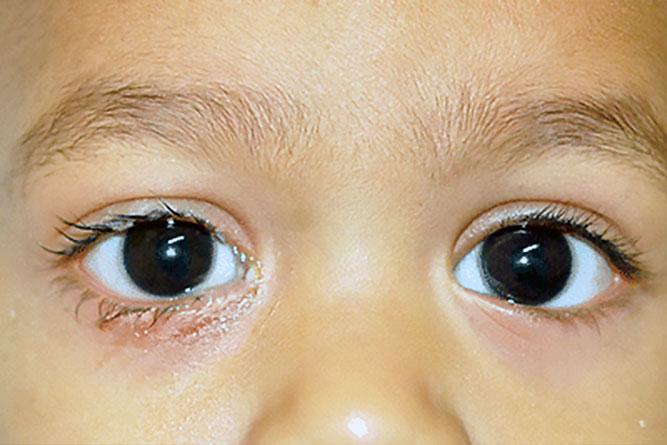 congenital-lacrimal-duct-obstruction