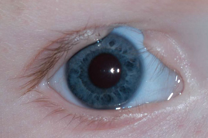 eyelid-coloboma
