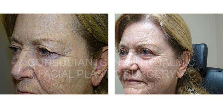 Blepharoplasty with CO2 laser skin resurfacing of both lower eyelids / Ptosis repair of both upper eyelids 3