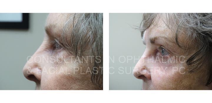 Blepharoplasty with Co2 Laser Skin Resurfacing of Both Lower Eyelids - Consultants in Ophthalmic and Facial Plastic Surgery