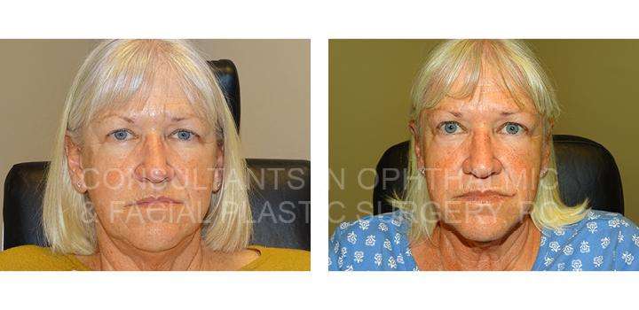 Temporal Only Endoscopic Brow Lift - Consultants in Ophthalmic and Facial Plastic Surgery