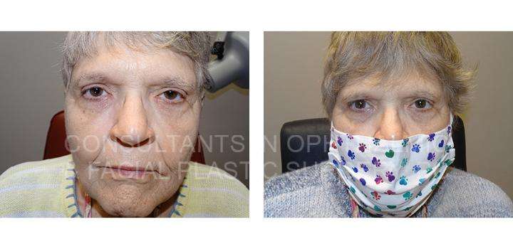 Repair Ptosis of Both Upper Eyelids - Consultants in Ophthalmic and Facial Plastic Surgery