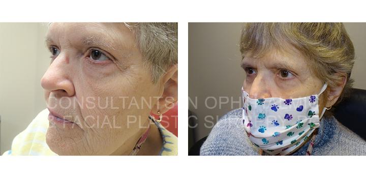 Repair Ptosis of Both Upper Eyelids - Consultants in Ophthalmic and Facial Plastic Surgery