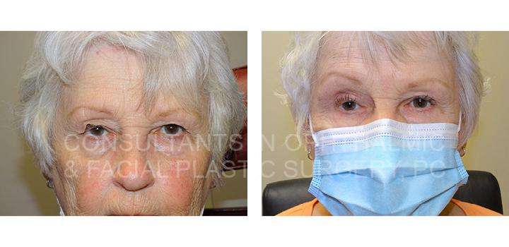 Blepharoplasty with Crease Elevation Both Upper Eyelids - Consultants in Ophthalmic and Facial Plastic Surgery