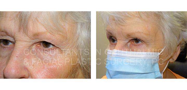 Blepharoplasty with Crease Elevation Both Upper Eyelids - Consultants in Ophthalmic and Facial Plastic Surgery
