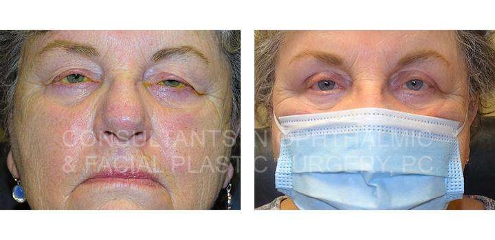 Repair Ptosis Both Upper Eyelids - Consultants in Ophthalmic and Facial Plastic Surgery