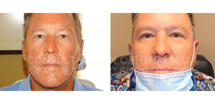 Blepharoplasty of Both Upper Lids - Consultants in Ophthalmic and Facial Plastic Surgery
