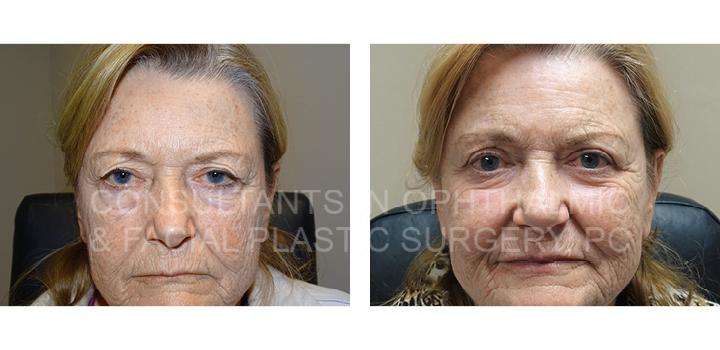 Blepharoplasty with Co2 Laser Skin Resurfacing of Both Lower Eyelids / Ptosis Repair of Both Upper Eyelids - Consultants in Ophthalmic and Facial Plastic Surgery