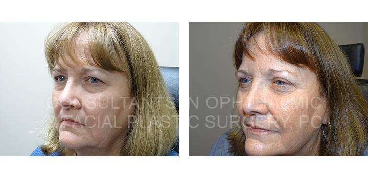 Blepharoplasty of both upper eyelids 3