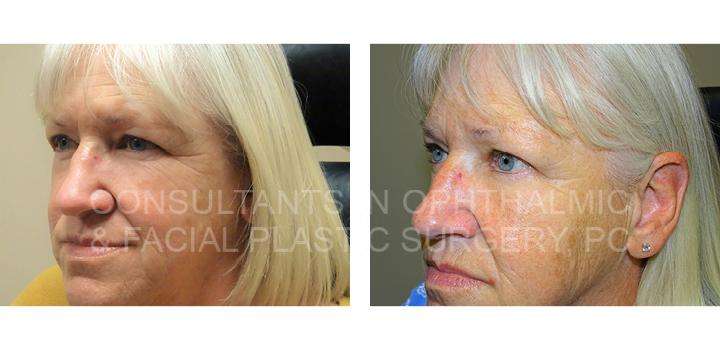 Temporal only endoscopic brow lift 9