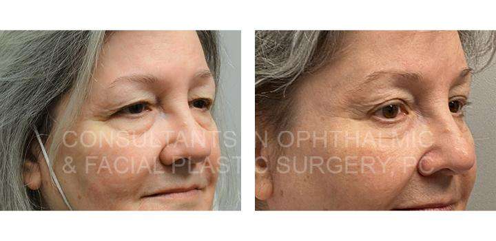 Endoscopic forehead and brow lift / Blepharoplasty of both upper lids / Transconjunctival excision herniated orbital fat with CO2 laser skin resurfacing of both lower lids 9