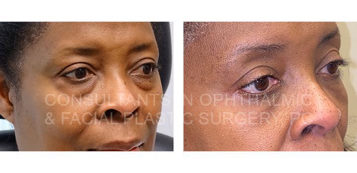 Herniated Orbital Fat Both Lower Eyelids - Consultants in Ophthalmic and Facial Plastic Surgery