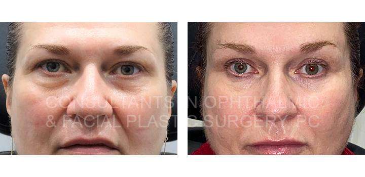 Blepharoplasty Both Upper Lids / Transconjunctival Excision Herniated Orbital Fat with Co2 Laser Skin Resurfacing of Both Lower Lids / Bilateral Endoscopic Forehead Lift - Consultants in Ophthalmic and Facial Plastic Surgery