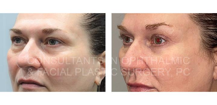 Blepharoplasty Both Upper Lids / Transconjunctival Excision Herniated Orbital Fat with Co2 Laser Skin Resurfacing of Both Lower Lids / Bilateral Endoscopic Forehead Lift - Consultants in Ophthalmic and Facial Plastic Surgery