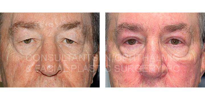 Blepharoplasty Both Upper Eyelids - Consultants in Ophthalmic and Facial Plastic Surgery