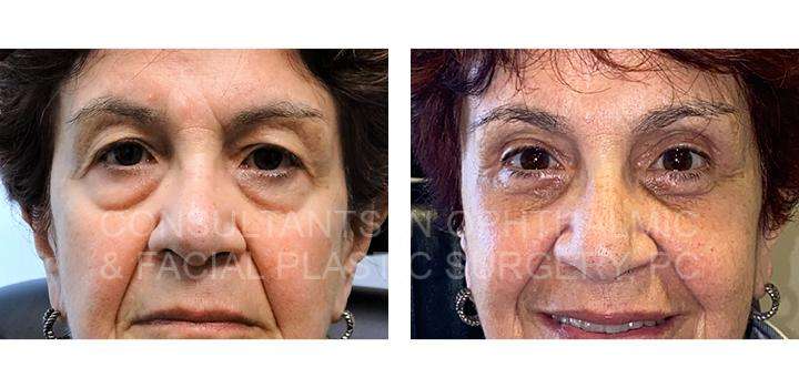 Blepharoplasty with Co2 Laser Skin Resurfacing of Both Lower Eyelids / Blepharoplasty of Both Upper Eyelids / Endoscopic Forehead and Brow Lift - Consultants in Ophthalmic and Facial Plastic Surgery
