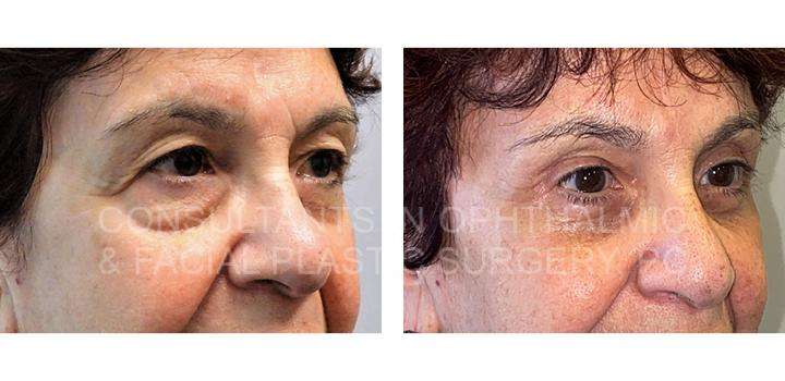 Blepharoplasty with Co2 Laser Skin Resurfacing of Both Lower Eyelids / Blepharoplasty of Both Upper Eyelids / Endoscopic Forehead and Brow Lift - Consultants in Ophthalmic and Facial Plastic Surgery