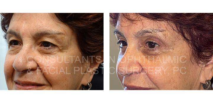 Blepharoplasty with CO2 laser skin resurfacing of both lower eyelids / Blepharoplasty of both upper eyelids / Endoscopic forehead and brow lift 3