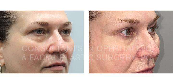 Blepharoplasty both upper lids / Transconjunctival excision herniated orbital fat with CO2 laser skin resurfacing of both lower lids / Bilateral endoscopic forehead lift 9