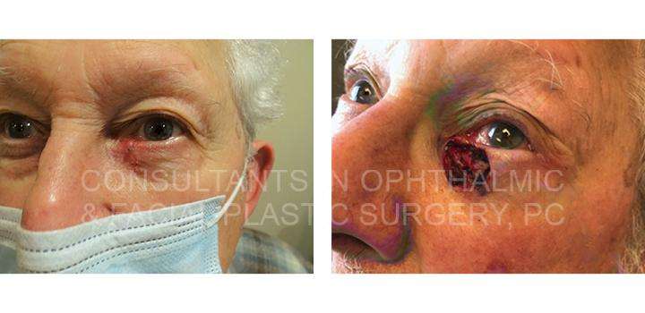 Reconstruction After Mohs Excision Left Lower Lid with Full Thickness Skin Graft / Canthoplasty Left Lower Eye Lid / Plastic Repair of Left Inferior Canaliculus - Consultants in Ophthalmic and Facial Plastic Surgery